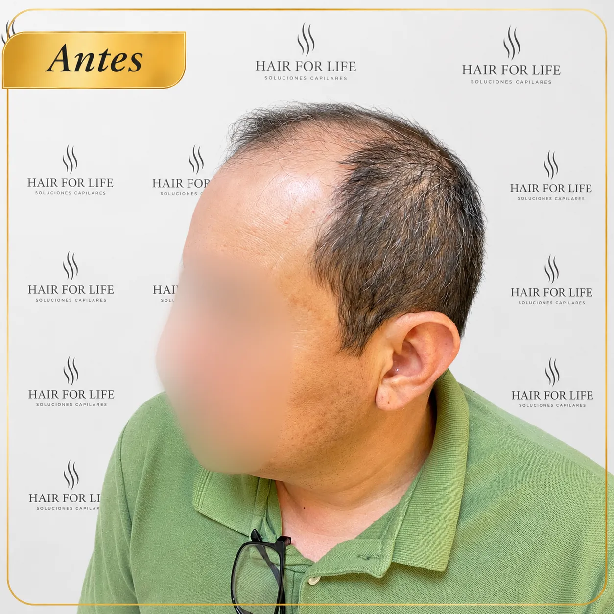 Caso 3 Antes