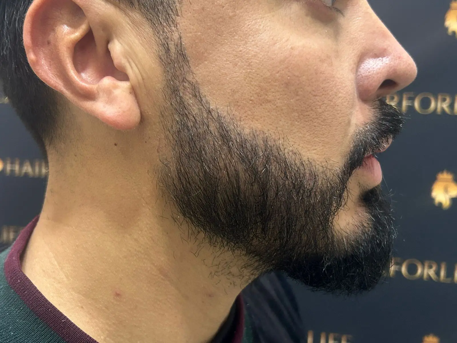 Injerto Barba